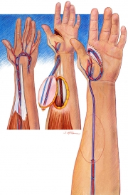 Ipsilateral Radial Forearm Flap