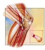 Peripheral Arterial Disease